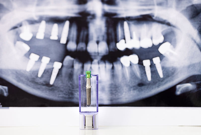 What to Expect During Dental Implant Procedure