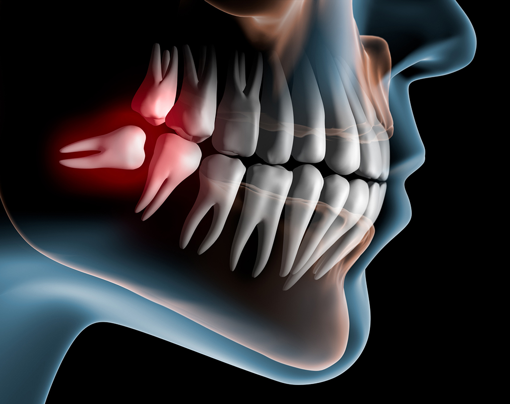 Oral Surgeon For Wisdom Teeth Extraction | Plano, TX