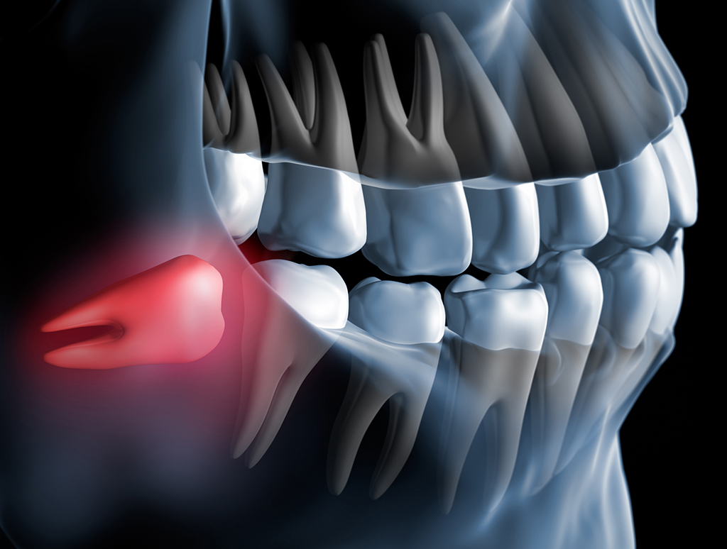 Choose An Oral Surgeon For Your Wisdom Teeth Removal | Plano, TX