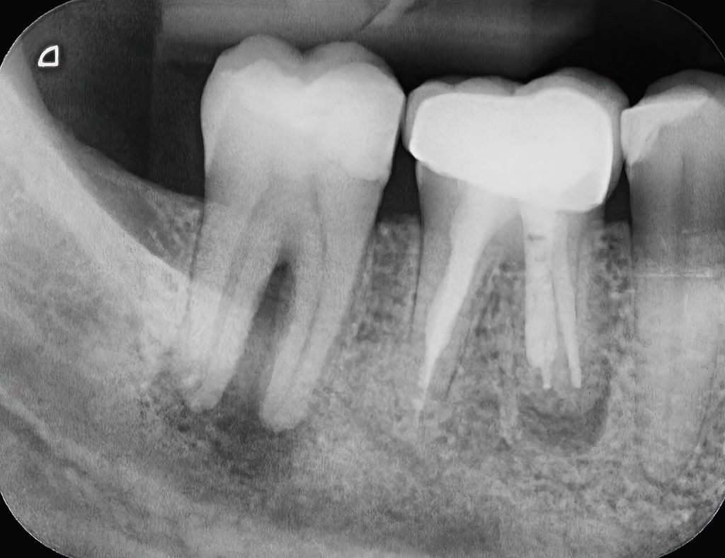How Tooth Abscesses Can Impact Your Health And When To Call An Oral Surgeon | Plano, TX