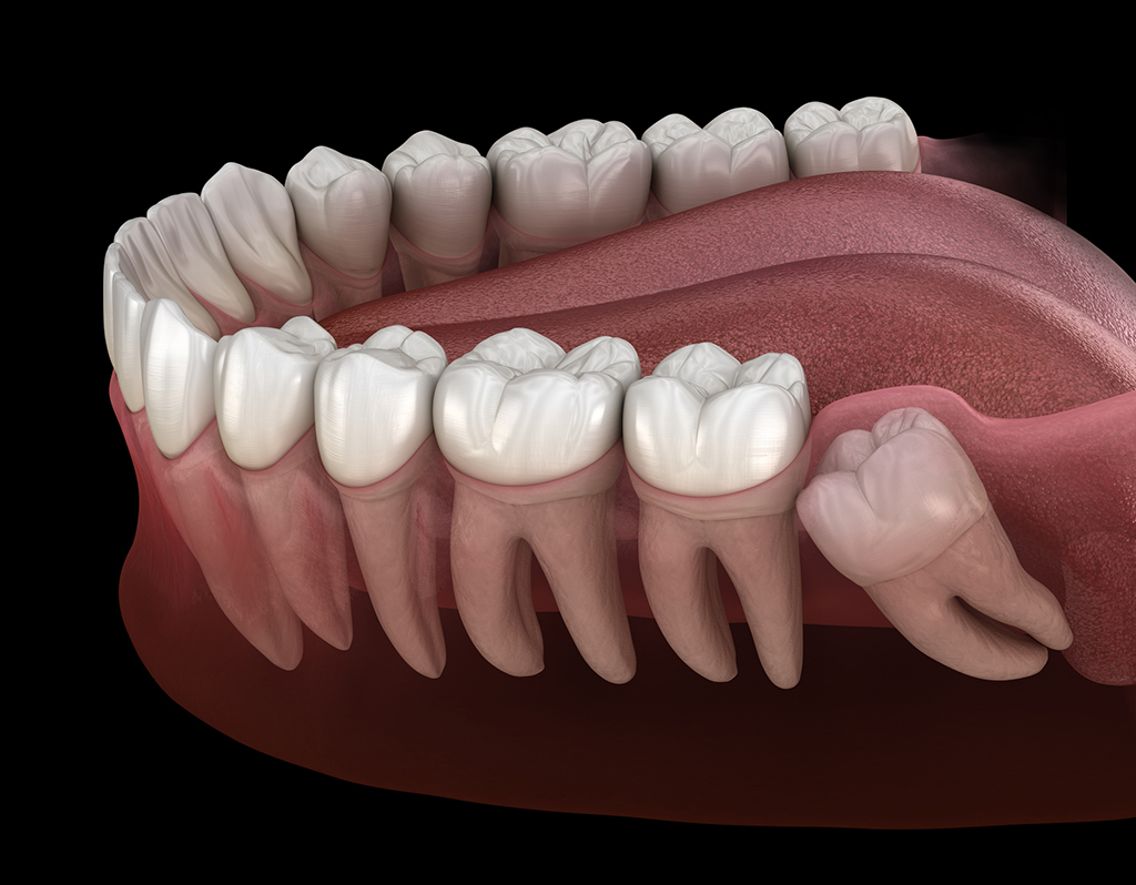 Why You Might Need Your Wisdom Teeth Removed