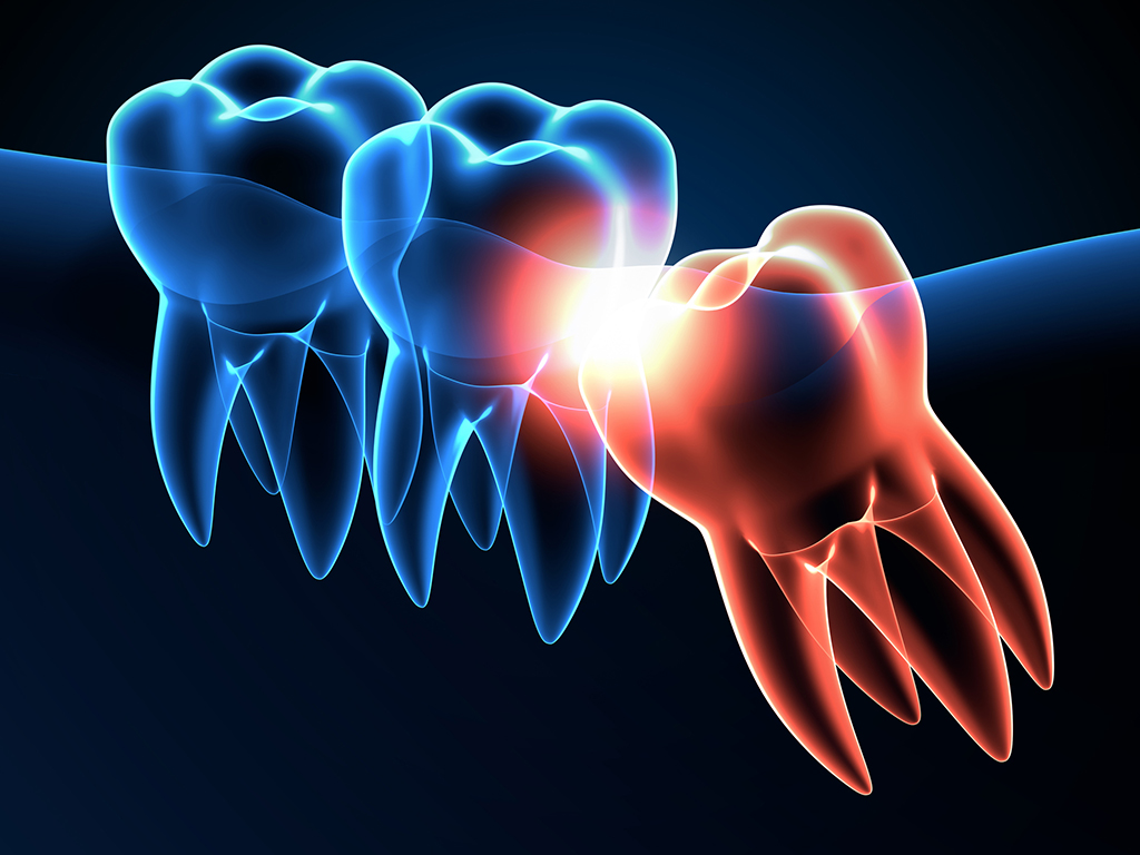 5 Complications That Can Arise From Delaying Wisdom Teeth Removal | McKinney, TX