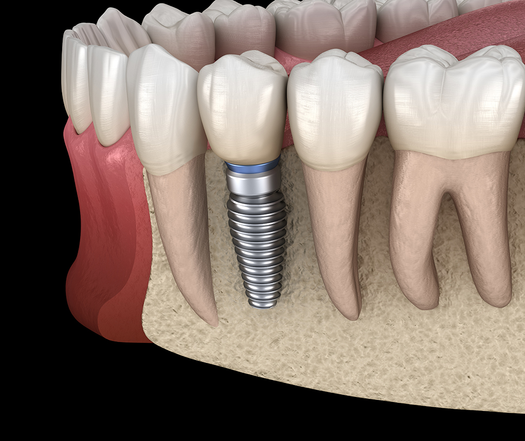 Bone Grafting By A Full Scope Oral Surgeon | Plano, TX