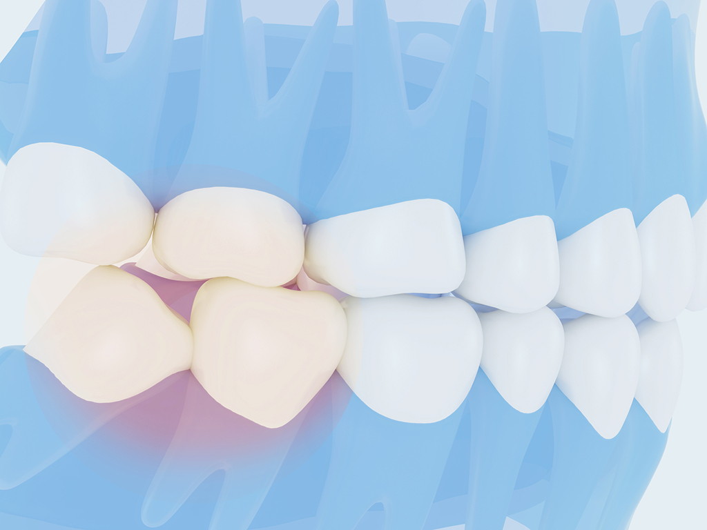 Wisdom Teeth Removal By A Top Oral Surgeon | McKinney, TX