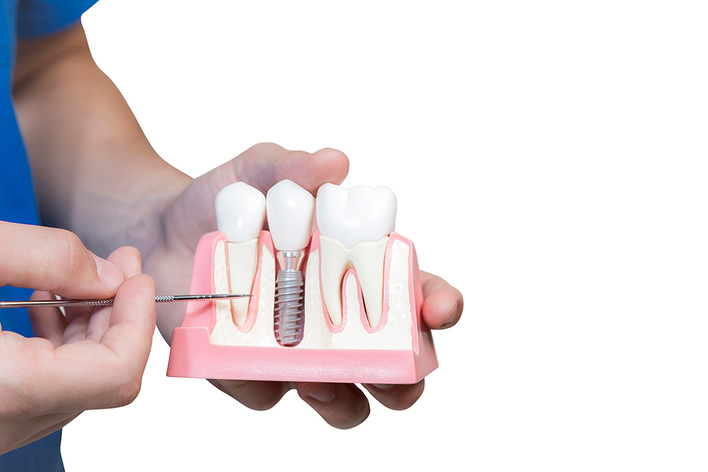 Need An Oral Surgeon? Things to Know Before Getting Dental Implants | Frisco, TX