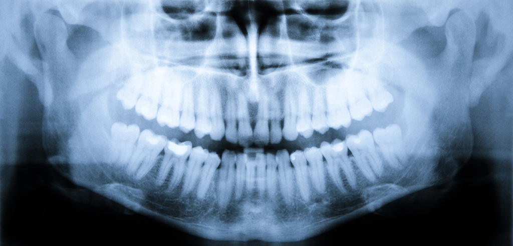 Common Bone-Related Conditions Treated By A Top Oral Surgeon | Plano, TX