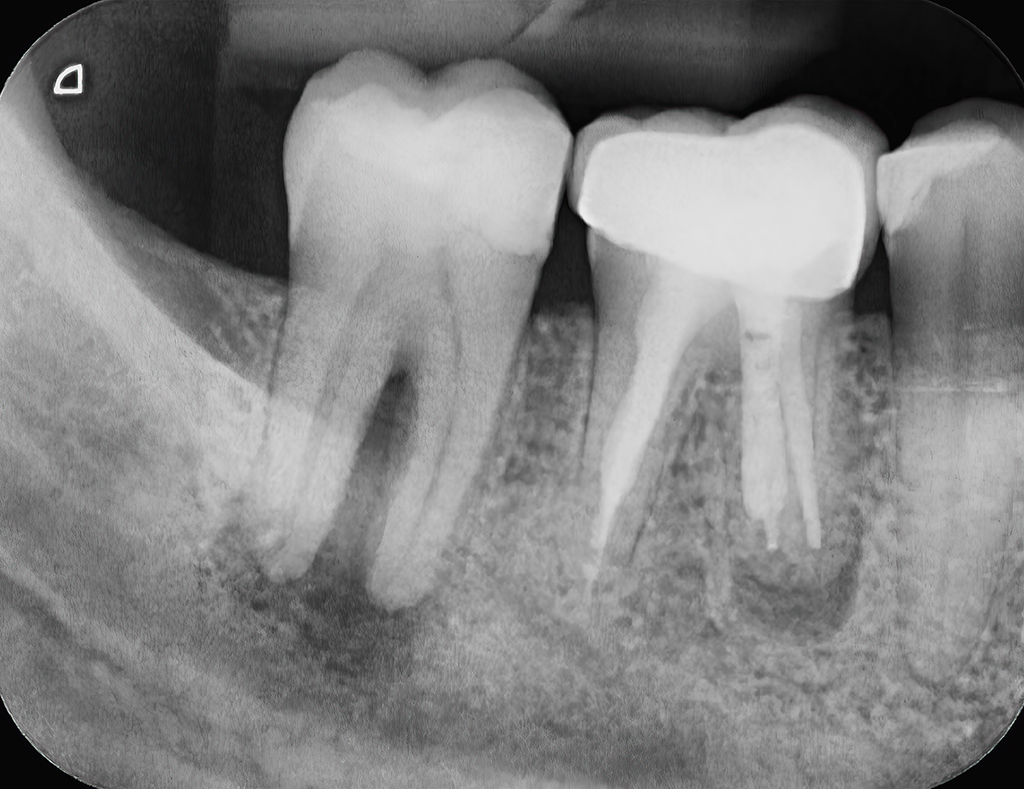 FAQs About Dental Osteomyelitis From An Experienced Oral Surgeon | Richardson, TX