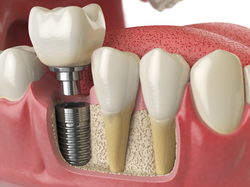 Benefits Of Dental Implants By An Oral Surgeon | Frisco, TX