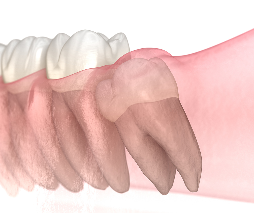 Professional Wisdom Teeth Removal | McKinney, TX